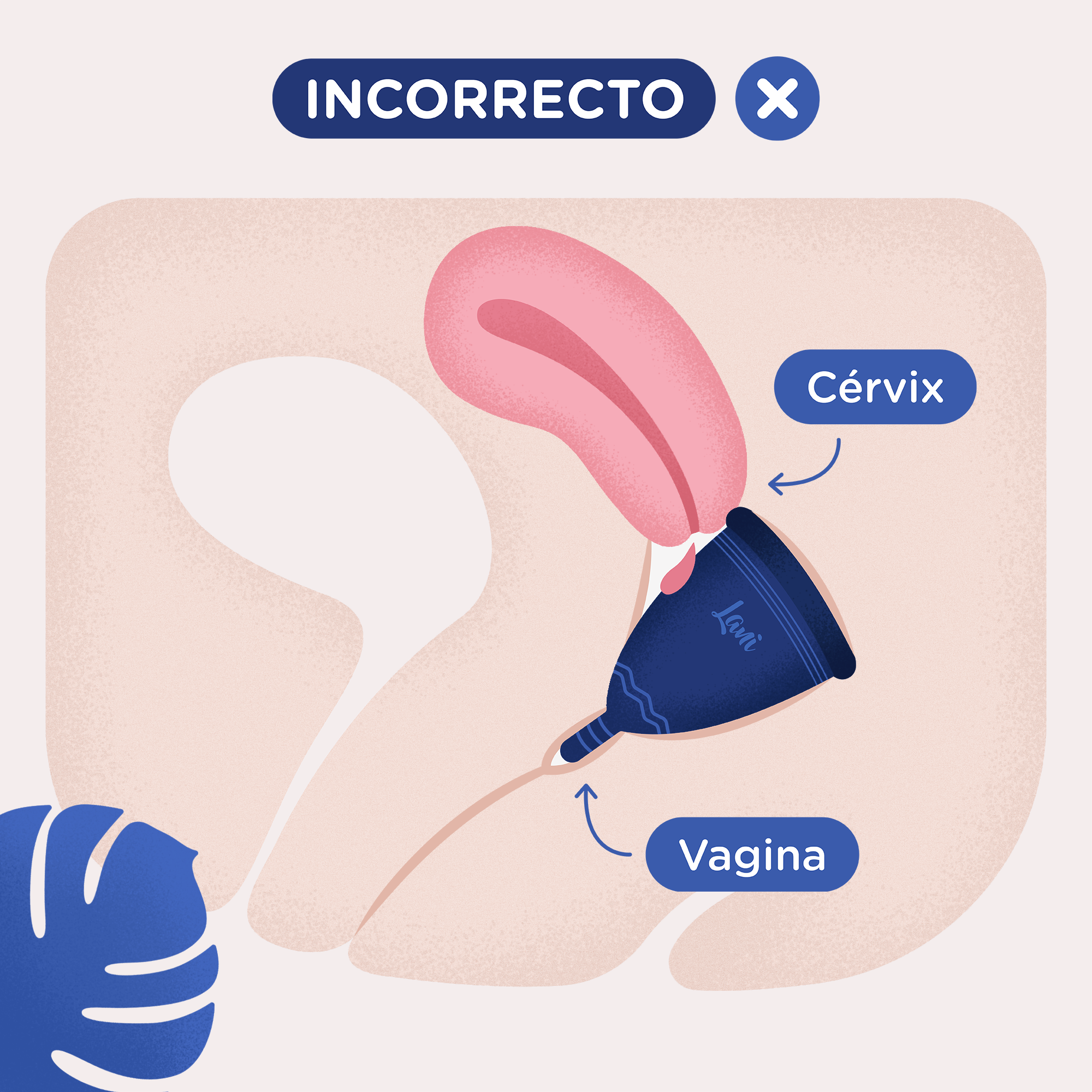 El cérvix y las fugas