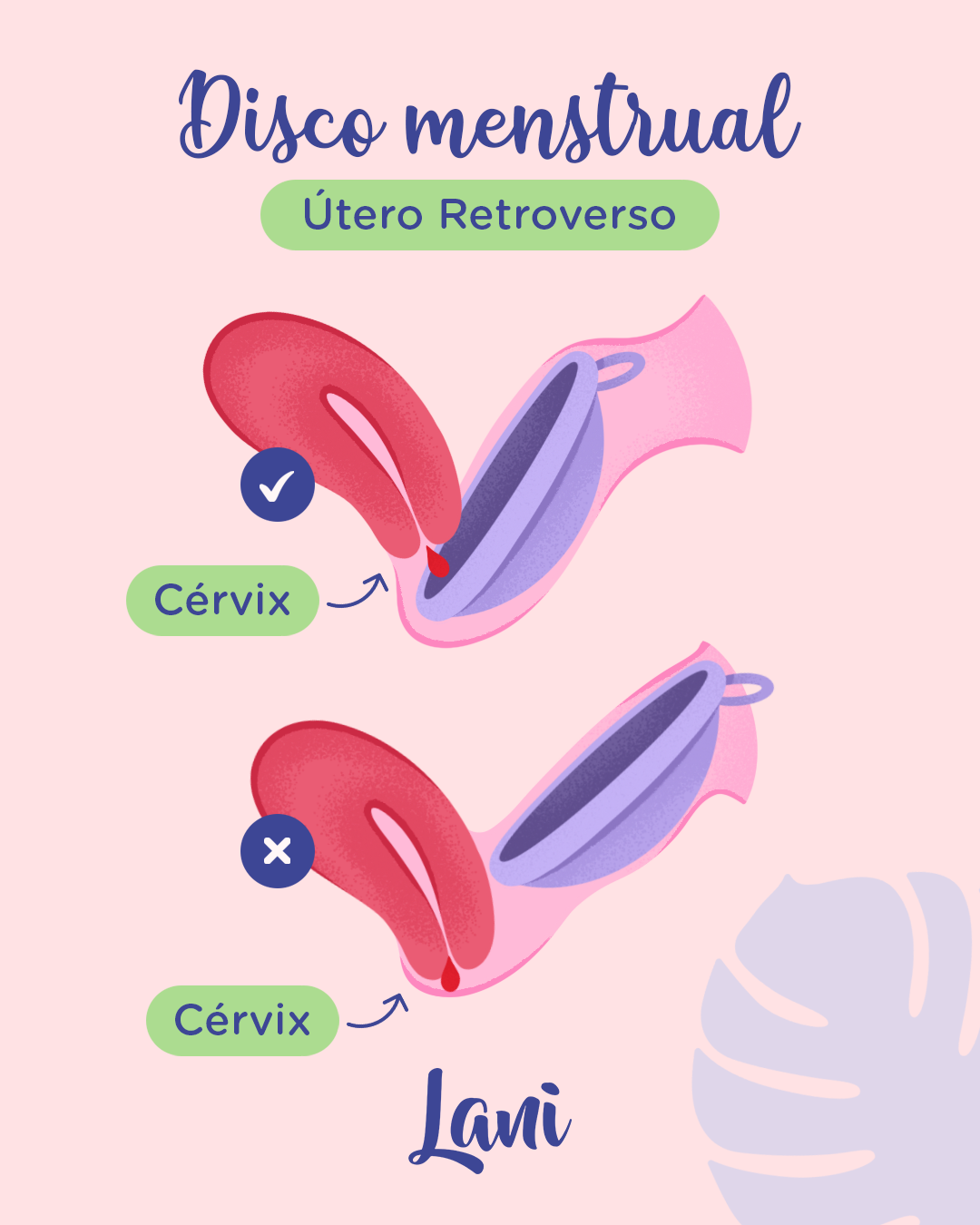 Disco Menstrual y Útero Retroverso