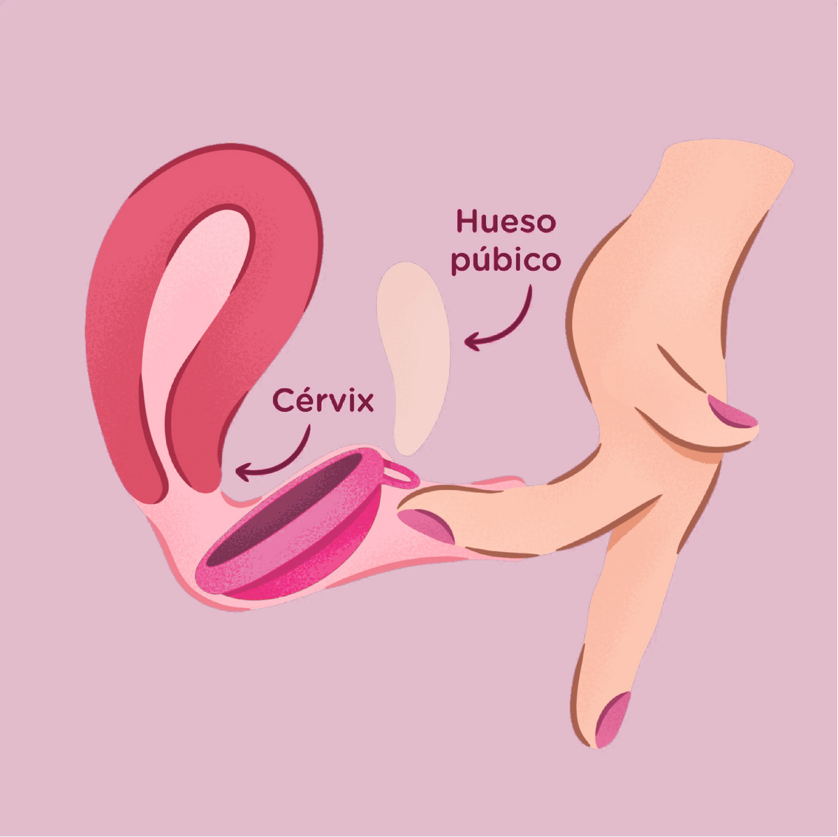 Ilustración: asegura el Disco LOOP Hibiscus detrás del hueso púbico